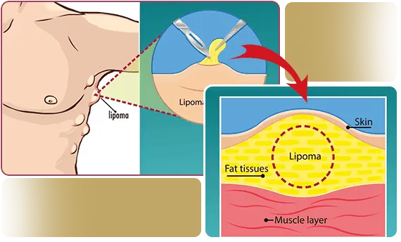 Lipoma Removal Process