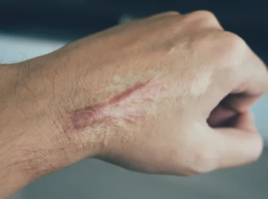 How We Diagnose Keloid