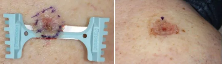 How We Perform a Biopsy